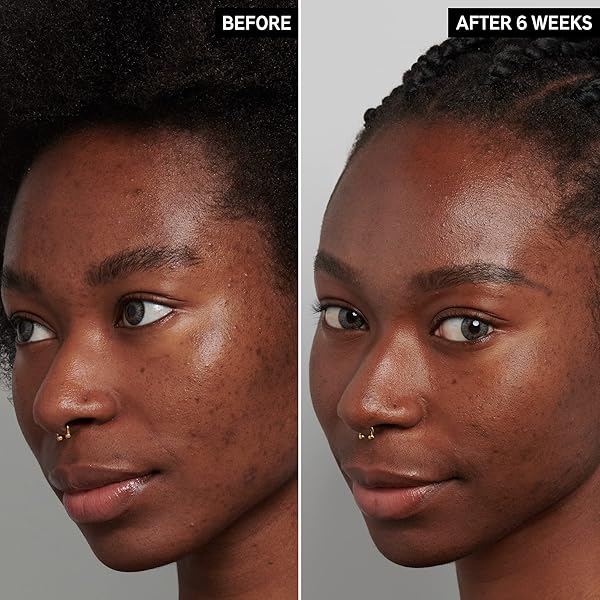 Transform Your Skin: The INKEY List Tranexamic Acid Serum for Dark Spots & Uneven Tone - 1 fl oz - Image 4